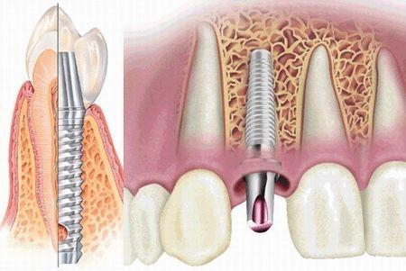 Как подготовиться к имплантации зубов