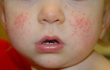 Доклад: Пищевая аллергия у детей