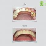 Импланты зубов: виды и сравнение